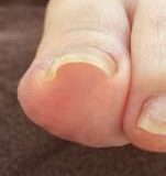 福岡西新巻き爪矯正センタービフォーアフター写真左足親指矯正前４０代女性